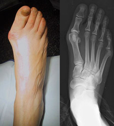 Example of a bunion and corresponding x-ray