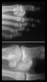 Examples of calcification in the joints of the foot requiring hand made shoes